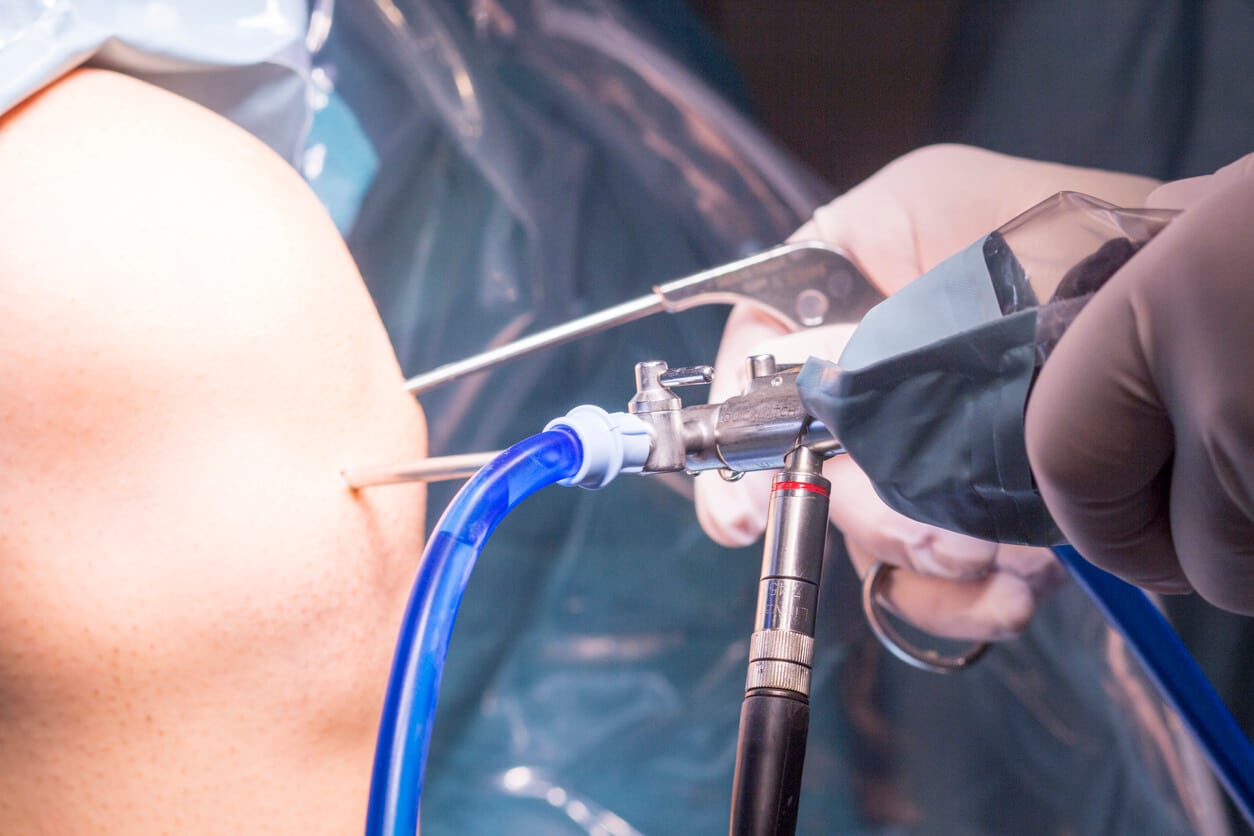 Minimally Invasive Arthroscopy