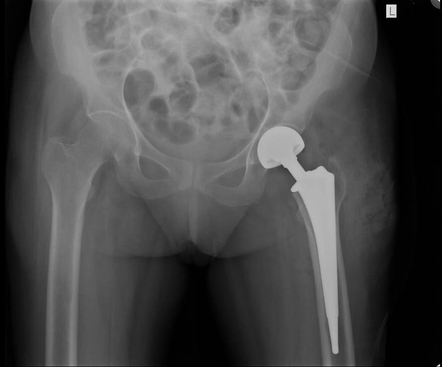 Precision Joint Replacement