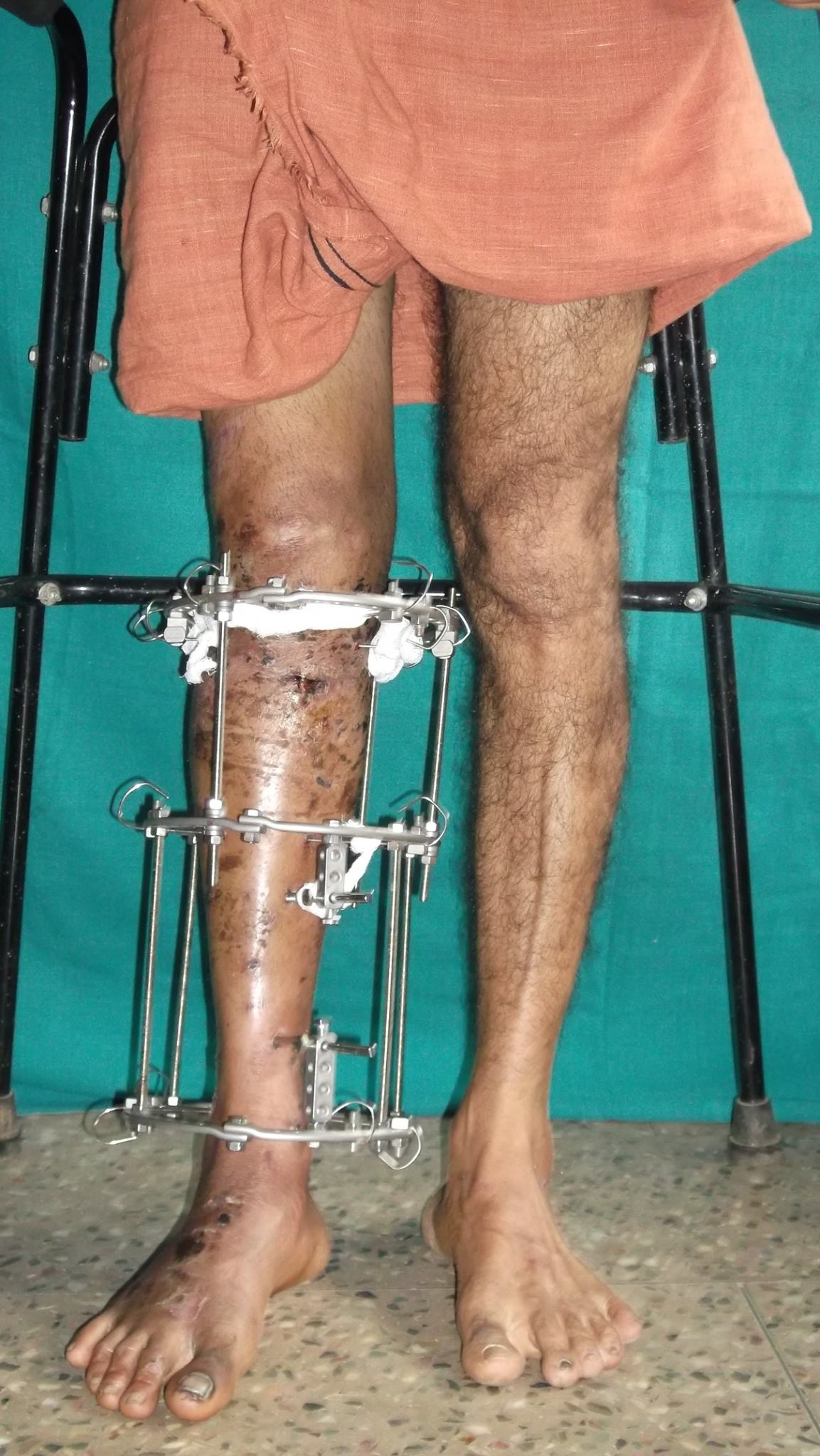 Complex Reconstructive Limb Surgery