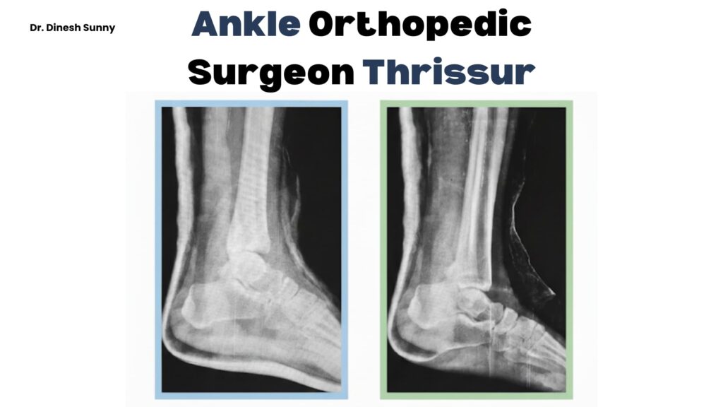 Ankle orthopedic surgeon thrissur