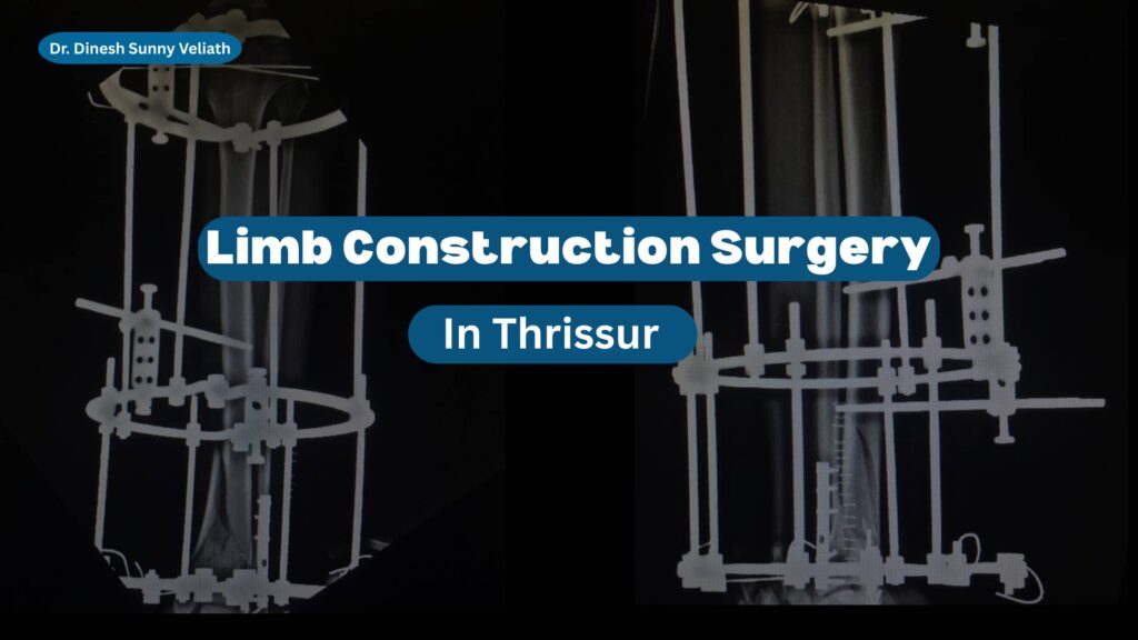 Limb Reconstruction Surgery
