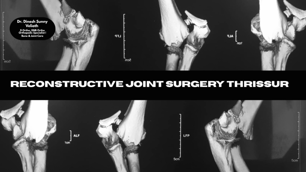 reconstructive joint surgery Thrissur