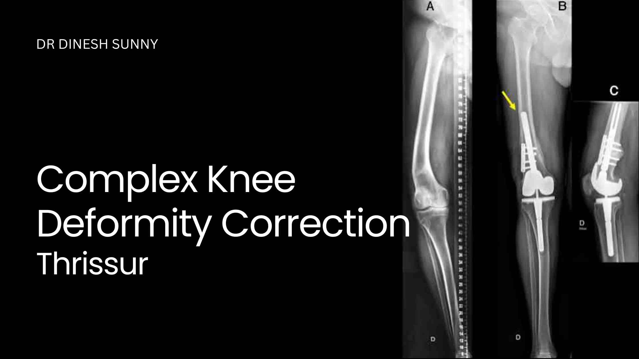 Complex knee deformity correction Thrissur