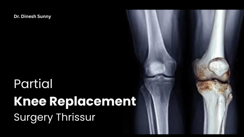 PARTIAL KNEE REPLACEMENT SURGERY THRISSUR