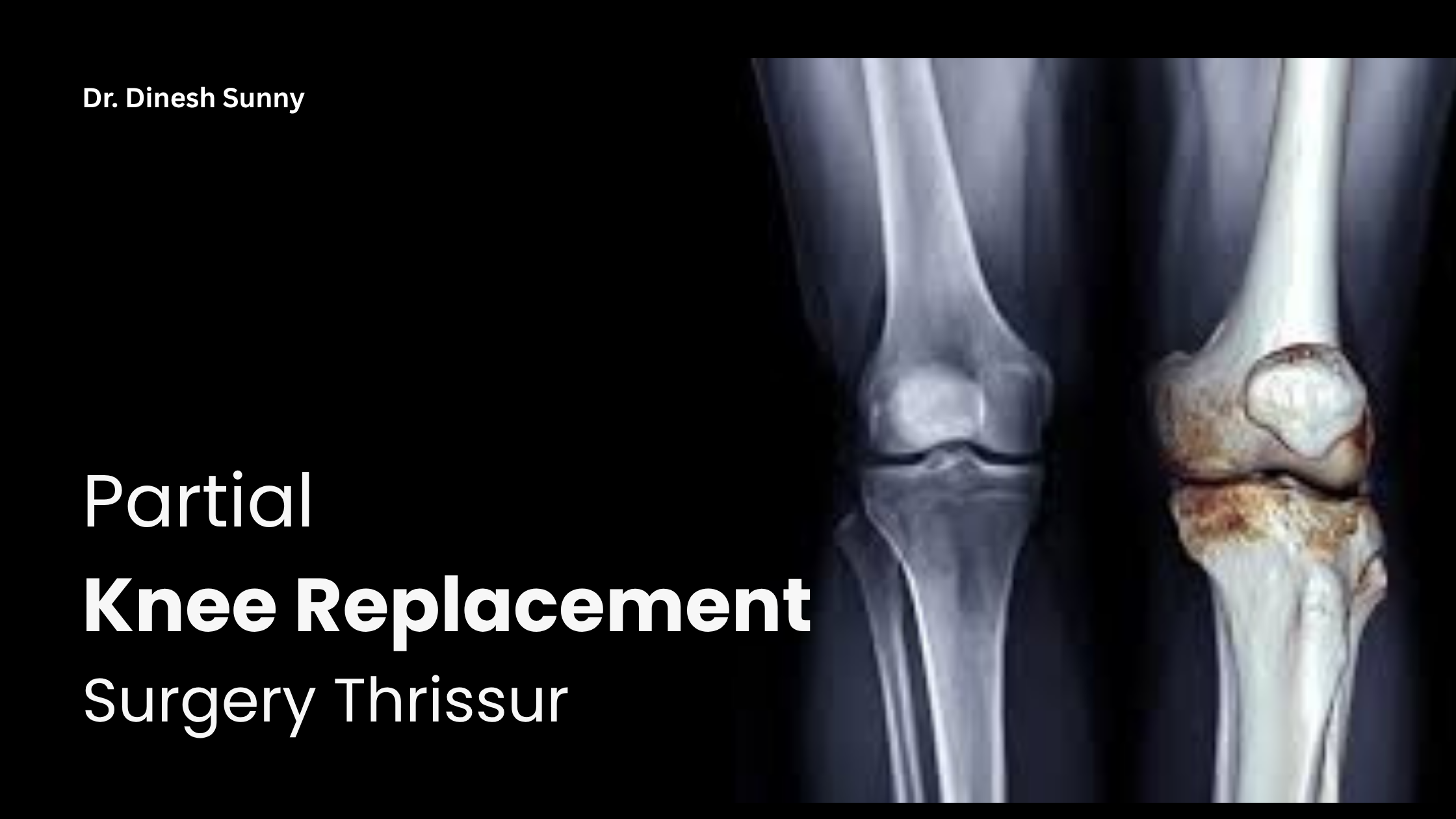 PARTIAL KNEE REPLACEMENT SURGERY THRISSUR