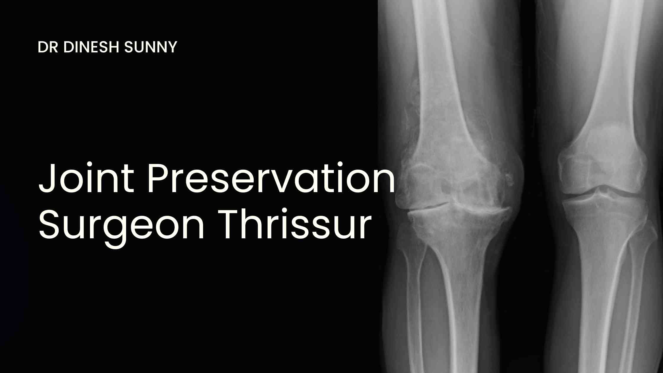 Joint preservation surgeon Thrissur