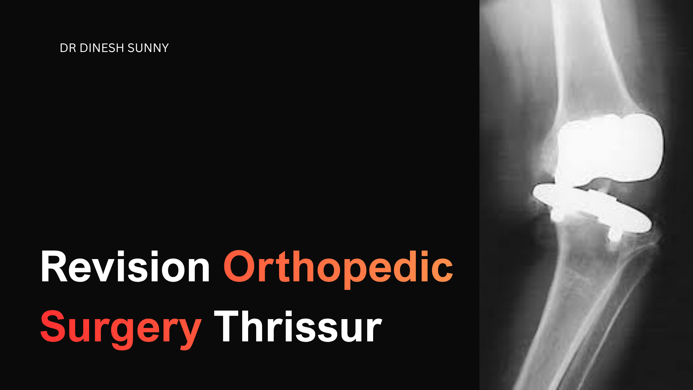revision orthopedic surgery Thrissur